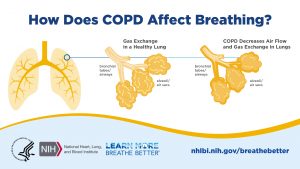 An infographic comparing the function of a healthy lung and a lung with COPD. The title text is How Does COPD Affect Breathing? Below that is a row of 3 images. The leftmost is a full pair of lungs. The center depicts gas exchange in a healthy lung, with arrows representing air circulating freely. The last image shows how inflammation and damage from COPD restricts air movement in the lungs.