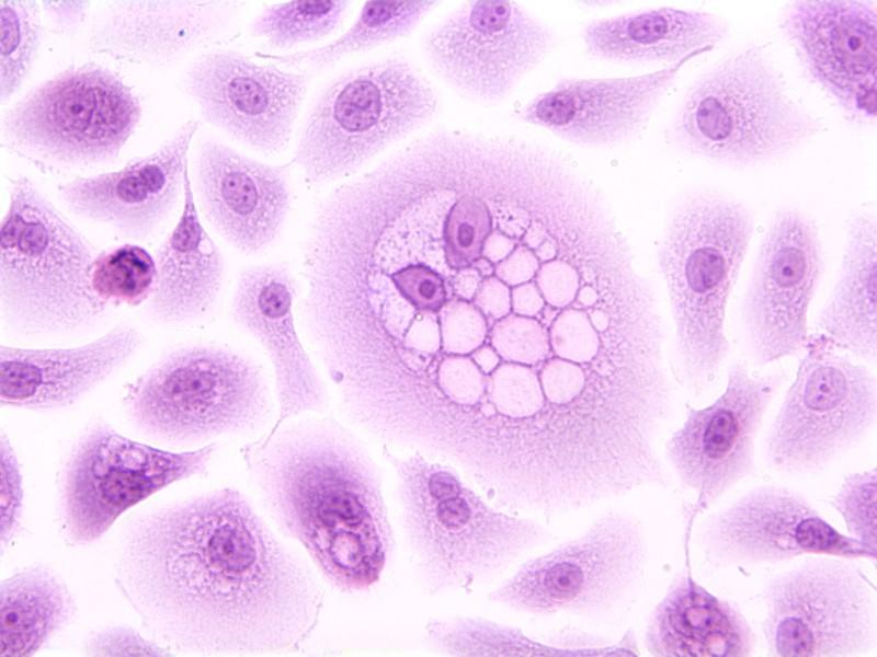 Microscope image of cervical cells, including an HPV-infected precancerous cell